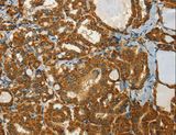 C15orf2 Antibody - Immunohistochemistry of paraffin-embedded Human thyroid cancer using NPAP1 Polyclonal Antibody at dilution of 1:60.