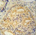 C16orf13 Antibody - CP013 antibody immunohistochemistry of formalin-fixed and paraffin-embedded human prostate carcinoma followed by peroxidase-conjugated secondary antibody and DAB staining.