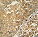 C18orf25 / ARKL1 Antibody - CR025 antibody immunohistochemistry of formalin-fixed and paraffin-embedded human bladder carcinoma followed by peroxidase-conjugated secondary antibody and DAB staining.