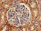 C1orf105 Antibody - Immunohistochemistry of paraffin-embedded human lung cancer using C1orf105 Antibody at dilution of 1:100
