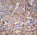 C1orf107 / DEF Antibody - DEF Antibody immunohistochemistry of formalin-fixed and paraffin-embedded human hepatocarcinoma followed by peroxidase-conjugated secondary antibody and DAB staining.