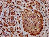 C1orf38 Antibody - Immunohistochemistry Dilution at 1:400 and staining in paraffin-embedded human pancreatic cancer performed on a Leica BondTM system. After dewaxing and hydration, antigen retrieval was mediated by high pressure in a citrate buffer (pH 6.0). Section was blocked with 10% normal Goat serum 30min at RT. Then primary antibody (1% BSA) was incubated at 4°C overnight. The primary is detected by a biotinylated Secondary antibody and visualized using an HRP conjugated SP system.