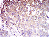 C1qRP / CD93 Antibody - IHC of paraffin-embedded esophageal cancer tissues using CD93 mouse monoclonal antibody with DAB staining.