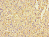 C3orf36 Antibody - Immunohistochemistry of paraffin-embedded human melanoma using C3orf36 Antibody at dilution of 1:100