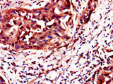 C4orf26 Antibody - Immunohistochemistry of paraffin-embedded human bladder cancer using ODAPH Antibody at dilution of 1:100