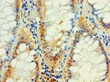 C4orf3 Antibody - Immunohistochemistry of paraffin-embedded human colon cancer using antibody at 1:100 dilution.  This image was taken for the unconjugated form of this product. Other forms have not been tested.