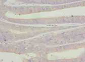C9orf43 Antibody - Immunohistochemistry of paraffin-embedded human endometrial cancer using antibody at dilution of 1:100.