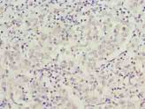 C9orf64 Antibody - Immunohistochemistry of paraffin-embedded human lung cancer using antibody at dilution of 1:100.