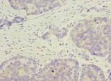 C9orf89 Antibody - Immunohistochemistry of paraffin-embedded human gastric cancer using antibody at dilution of 1:100.