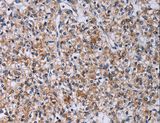 CA4 / Carbonic Anhydrase IV Antibody - Immunohistochemistry of paraffin-embedded Human prostate cancer using CA4 Polyclonal Antibody at dilution of 1:30.