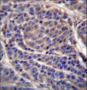 CA6 / Carbonic Anhydrase 6 Antibody - CA6 Antibody immunohistochemistry of formalin-fixed and paraffin-embedded human melanoma followed by peroxidase-conjugated secondary antibody and DAB staining.