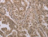 CAB39 / MO25 Antibody - Immunohistochemistry of paraffin-embedded Human gastric cancer using CAB39 Polyclonal Antibody at dilution of 1:50.