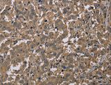 CAB39 / MO25 Antibody - Immunohistochemistry of paraffin-embedded Human liver cancer using CAB39 Polyclonal Antibody at dilution of 1:40.