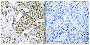 CAGE1 / Cancer Antigen 1 Antibody - Immunohistochemistry analysis of paraffin-embedded human breast carcinoma tissue, using CAGE1 Antibody. The picture on the right is blocked with the synthesized peptide.