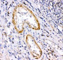 CALB2 / Calretinin Antibody - Calretinin antibody IHC-paraffin: Human Intestinal Cancer Tissue.