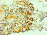 CALCA Antibody - Immunohistochemical of paraffin-embedded human thyroid tissues using CALCA Monoclonal Antibody at dilution of 1:200