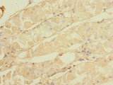 CALHM3 Antibody - Immunohistochemistry of paraffin-embedded human gastric cancer using CALHM3 Antibody at dilution of 1:100