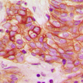 CALM1 / Calmodulin Antibody - Immunohistochemical analysis of Calmodulin (pT80/S82) staining in human breast cancer formalin fixed paraffin embedded tissue section. The section was pre-treated using heat mediated antigen retrieval with sodium citrate buffer (pH 6.0). The section was then incubated with the antibody at room temperature and detected using an HRP conjugated compact polymer system. DAB was used as the chromogen. The section was then counterstained with hematoxylin and mounted with DPX. w
