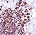 CAMK1 / CAMKI Antibody - Formalin-fixed and paraffin-embedded human cancer tissue reacted with the primary antibody, which was peroxidase-conjugated to the secondary antibody, followed by DAB staining. This data demonstrates the use of this antibody for immunohistochemistry; clinical relevance has not been evaluated. BC = breast carcinoma; HC = hepatocarcinoma.