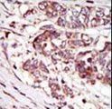 CAMK1G / CaMKI gamma Antibody - Formalin-fixed and paraffin-embedded human cancer tissue reacted with the primary antibody, which was peroxidase-conjugated to the secondary antibody, followed by AEC staining. This data demonstrates the use of this antibody for immunohistochemistry; clinical relevance has not been evaluated. BC = breast carcinoma; HC = hepatocarcinoma.