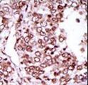 CAMK2G / CaMK II Gamma Antibody - Formalin-fixed and paraffin-embedded human cancer tissue reacted with the primary antibody, which was peroxidase-conjugated to the secondary antibody, followed by AEC staining. This data demonstrates the use of this antibody for immunohistochemistry; clinical relevance has not been evaluated. BC = breast carcinoma; HC = hepatocarcinoma.