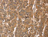 CAPZA3 Antibody - Immunohistochemistry of paraffin-embedded Human esophagus cancer using CAPZA3 Polyclonal Antibody at dilution of 1:40.
