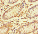 Carboxylesterase 3 / CES3 Antibody - Immunohistochemistry of paraffin-embedded human colon cancer at dilution of 1:100