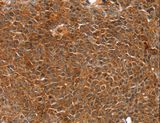 CARP / ANKRD1 Antibody - Immunohistochemistry of paraffin-embedded Human ovarian cancer using ANKRD1 Polyclonal Antibody at dilution of 1:20.