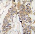 CASC3 / MLN51 Antibody - Formalin-fixed and paraffin-embedded human breast carcinoma tissue reacted with CASC3 Antibody , which was peroxidase-conjugated to the secondary antibody, followed by DAB staining. This data demonstrates the use of this antibody for immunohistochemistry; clinical relevance has not been evaluated.