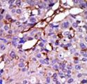 CASK Antibody - Formalin-fixed and paraffin-embedded human cancer tissue reacted with the primary antibody, which was peroxidase-conjugated to the secondary antibody, followed by DAB staining. This data demonstrates the use of this antibody for immunohistochemistry; clinical relevance has not been evaluated. BC = breast carcinoma; HC = hepatocarcinoma.