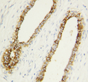 CASP1 / Caspase 1 Antibody - CASP1 / Caspase 1 antibody. IHC(P): Human Breast Cancer Tissue.