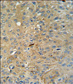 CASP3 / Caspase 3 Antibody - Cleaved-CASP3 (Asp175)Antibody IHC of formalin-fixed and paraffin-embedded human lung carcinoma followed by peroxidase-conjugated secondary antibody and DAB staining. This data demonstrates the use of the Cleaved-CASP3 (Asp175)Antibody for immunohistochemistry.