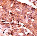 CASP6 / Caspase 6 Antibody - Formalin-fixed and paraffin-embedded human cancer tissue reacted with the primary antibody, which was peroxidase-conjugated to the secondary antibody, followed by AEC staining. This data demonstrates the use of this antibody for immunohistochemistry; clinical relevance has not been evaluated. BC = breast carcinoma; HC = hepatocarcinoma.