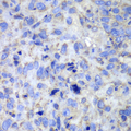 CASP7 / Caspase 7 Antibody - Immunohistochemistry of paraffin-embedded human lung cancer using CASP7 antibodyat dilution of 1:100 (40x lens).