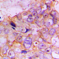 CASP7 / Caspase 7 Antibody - Immunohistochemical analysis of Caspase 7 staining in human lung cancer formalin fixed paraffin embedded tissue section. The section was pre-treated using heat mediated antigen retrieval with sodium citrate buffer (pH 6.0). The section was then incubated with the antibody at room temperature and detected using an HRP conjugated compact polymer system. DAB was used as the chromogen. The section was then counterstained with hematoxylin and mounted with DPX.