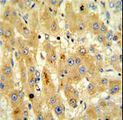CASP8 / Caspase 8 Antibody - Formalin-fixed and paraffin-embedded human hepatocarcinoma reacted with CASP8 Antibody , which was peroxidase-conjugated to the secondary antibody, followed by DAB staining. This data demonstrates the use of this antibody for immunohistochemistry; clinical relevance has not been evaluated.