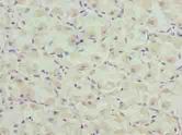 CASQ1 / Calsequestrin 1 Antibody - Immunohistochemistry of paraffin-embedded human gastric cancer using antibody at dilution of 1:100.