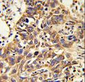 CAT / Catalase Antibody - Formalin-fixed and paraffin-embedded human lung carcinoma reacted with CAT Antibody , which was peroxidase-conjugated to the secondary antibody, followed by DAB staining. This data demonstrates the use of this antibody for immunohistochemistry; clinical relevance has not been evaluated.