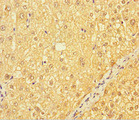 CATSPER4 Antibody - Immunohistochemistry of paraffin-embedded human liver cancer using CATSPER4 Antibody at dilution of 1:100