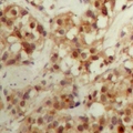 CBFB Antibody - Immunohistochemical analysis of CBFB staining in human breast cancer formalin fixed paraffin embedded tissue section. The section was pre-treated using heat mediated antigen retrieval with sodium citrate buffer (pH 6.0). The section was then incubated with the antibody at room temperature and detected with HRP and DAB as chromogen. The section was then counterstained with hematoxylin and mounted with DPX.