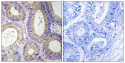 CBR3 Antibody - Immunohistochemistry analysis of paraffin-embedded human colon carcinoma tissue, using CBR3 Antibody. The picture on the right is blocked with the synthesized peptide.