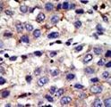 CBX4 Antibody - Formalin-fixed and paraffin-embedded human cancer tissue reacted with the primary antibody, which was peroxidase-conjugated to the secondary antibody, followed by AEC staining. This data demonstrates the use of this antibody for immunohistochemistry; clinical relevance has not been evaluated. BC = breast carcinoma; HC = hepatocarcinoma.