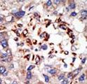 CBX8 Antibody - Formalin-fixed and paraffin-embedded human cancer tissue reacted with the primary antibody, which was peroxidase-conjugated to the secondary antibody, followed by DAB staining. This data demonstrates the use of this antibody for immunohistochemistry; clinical relevance has not been evaluated. BC = breast carcinoma; HC = hepatocarcinoma.