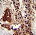 CCDC122 Antibody - CCDC122 antibody immunohistochemistry of formalin-fixed and paraffin-embedded human bladder carcinoma followed by peroxidase-conjugated secondary antibody and DAB staining.