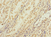 CCDC150 Antibody - Immunohistochemistry of paraffin-embedded human gastric cancer using CCDC150 Antibody at dilution of 1:100