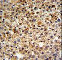 CCDC180 / C9orf174 Antibody - KIAA1529 Antibody IHC of formalin-fixed and paraffin-embedded human cervix carcinoma followed by peroxidase-conjugated secondary antibody and DAB staining.
