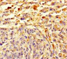 CCDC184 Antibody - Immunohistochemistry of paraffin-embedded human melanoma using CCDC184 Antibody at dilution of 1:100