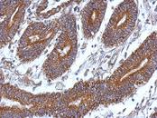 CCDC37 Antibody - IHC of paraffin-embedded Colon ca, using CCDC37 antibody at 1:500 dilution.