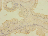 CCDC79 Antibody - Immunohistochemistry of paraffin-embedded human prostate cancer using TERB1 Antibody at dilution of 1:100
