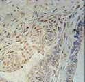 CCDC92 Antibody - CCD92 Antibody immunohistochemistry of formalin-fixed and paraffin-embedded human colon carcinoma followed by peroxidase-conjugated secondary antibody and DAB staining.